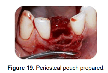 dental-sciences-pouch-prepared