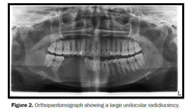 dental-sciences-radiolucency