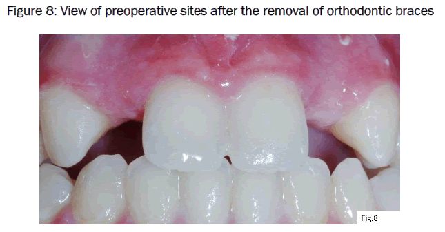 dental-sciences-removal-orthodontic-braces