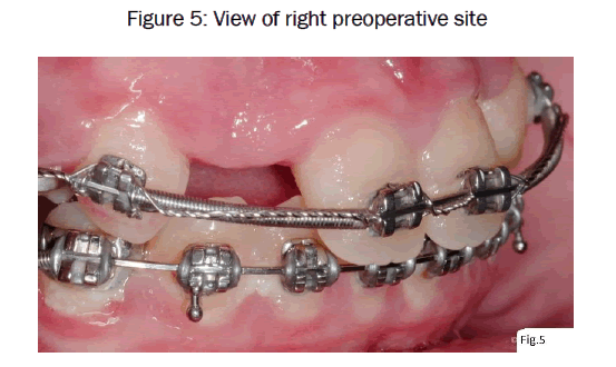 dental-sciences-right-preoperative-site