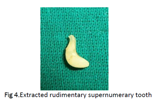 dental-sciences-rudimentary-supernumerary-tooth
