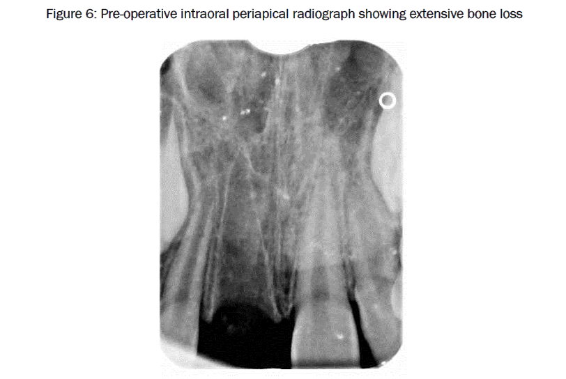 dental-sciences-showing-extensive-bone-loss
