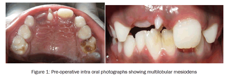 dental-sciences-showing-multilobular-mesiodens