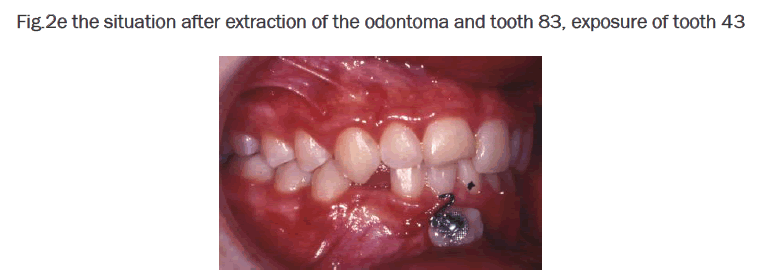 dental-sciences-situation-after-extraction-odontoma