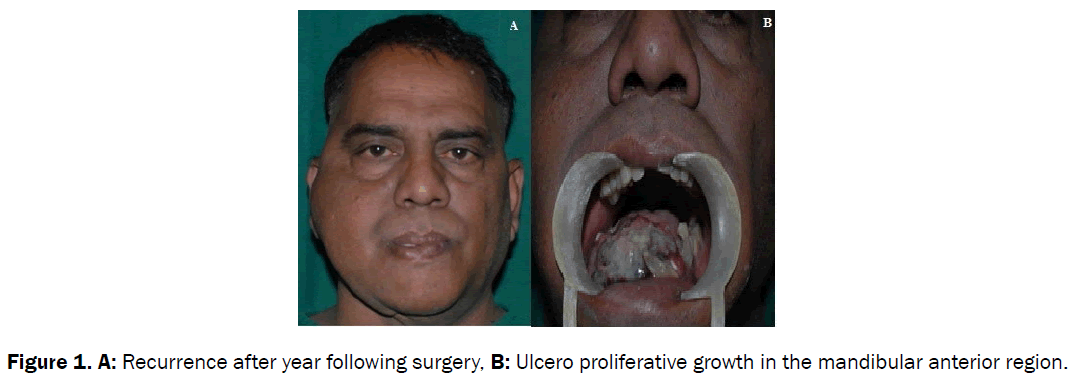 dental-sciences-surgery-ulcero-proliferative