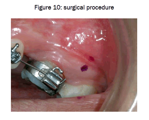 dental-sciences-surgical-procedure