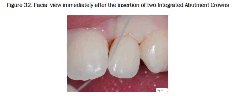 dental-sciences-two-Integrated-Abutment-Crowns