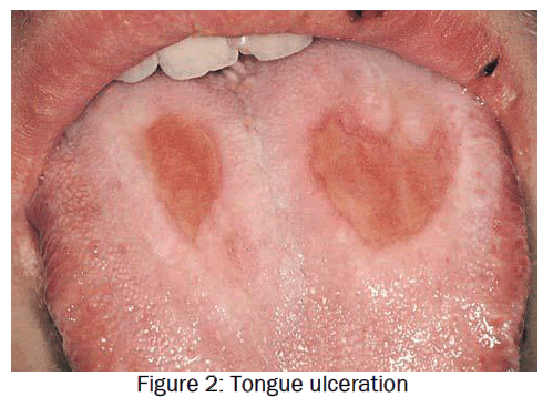 dental-sciences-ulceration