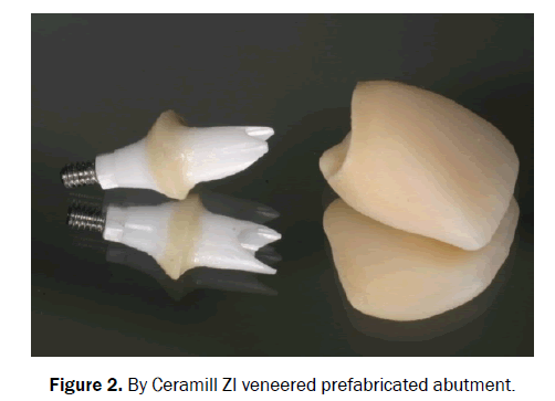 dental-sciences-veneered