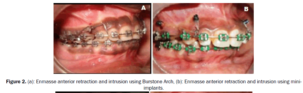 dental-sciences-veneered