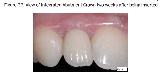 dental-sciences-weeks-after-being-inserted