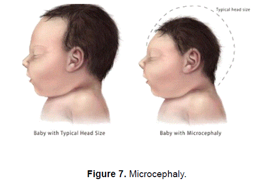 health-sciences-Microcephaly