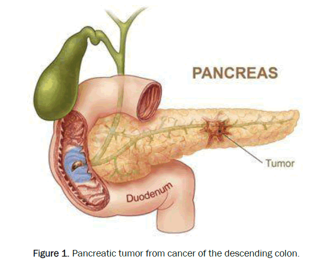 health-sciences-Pancreatic-tumor