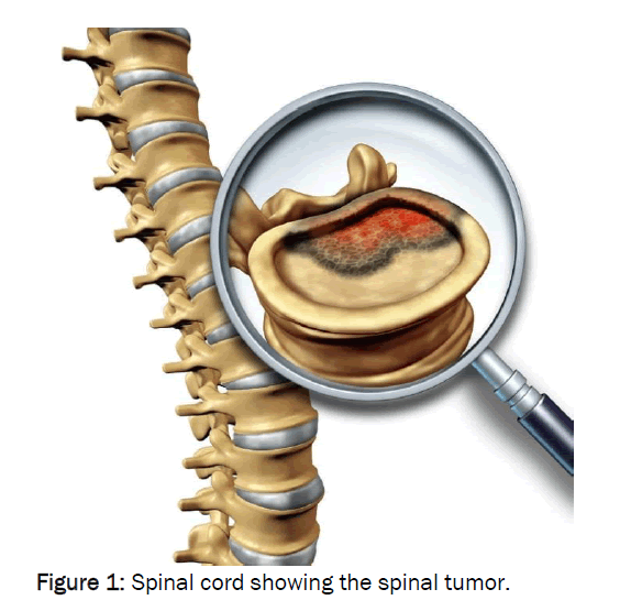 health-sciences-spinal-tumor