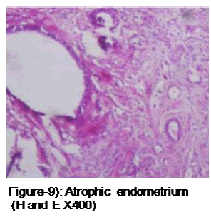 medical-and-health-sciences-Atrophic-endometrium