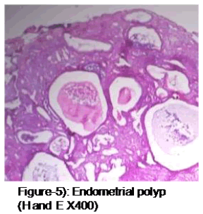 medical-and-health-sciences-Endometrial-polyp