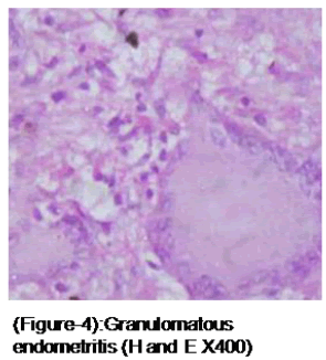 medical-and-health-sciences-Granulomatous-endometritis