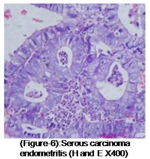 medical-and-health-sciences-Serous-carcinoma
