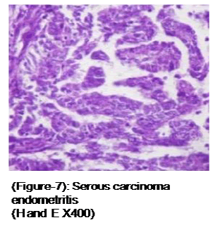 medical-and-health-sciences-carcinoma-endometritis