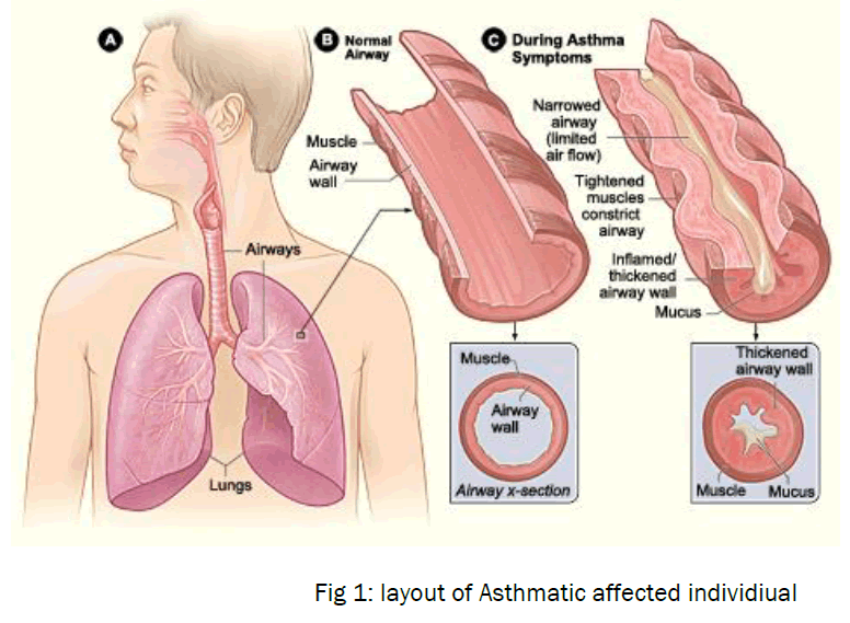 medical-health-sciences-Asthmatic-affected