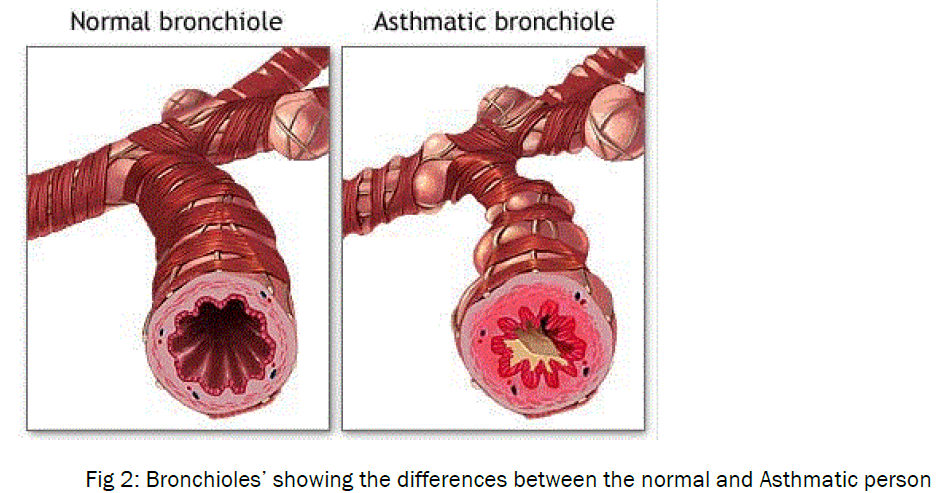 medical-health-sciences-Asthmatic-person