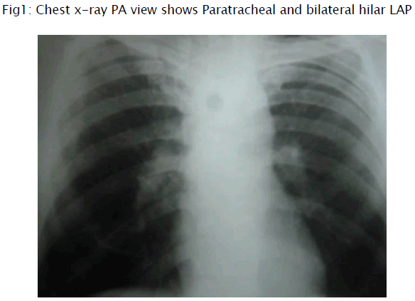 medical-health-sciences-Chest-x-ray-PA-view