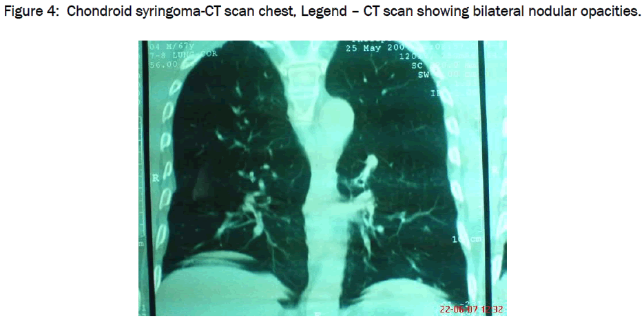 medical-health-sciences-Chondroid-syringoma-CT-scan-chest