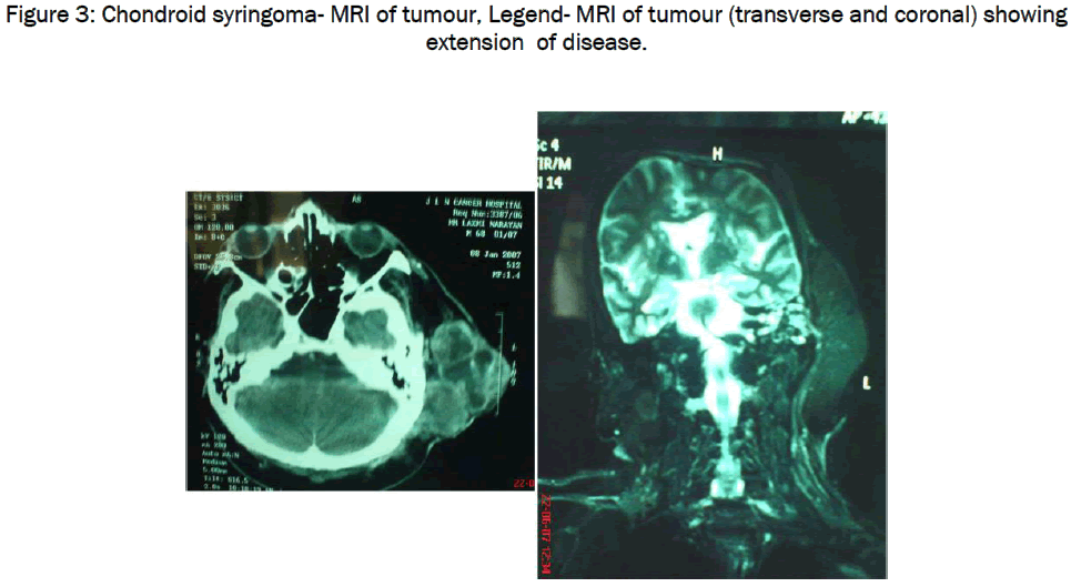 medical-health-sciences-Chondroid-syringoma-MRI-tumour