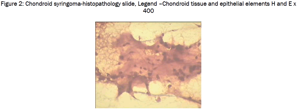 medical-health-sciences-Chondroid-syringoma-histopathology