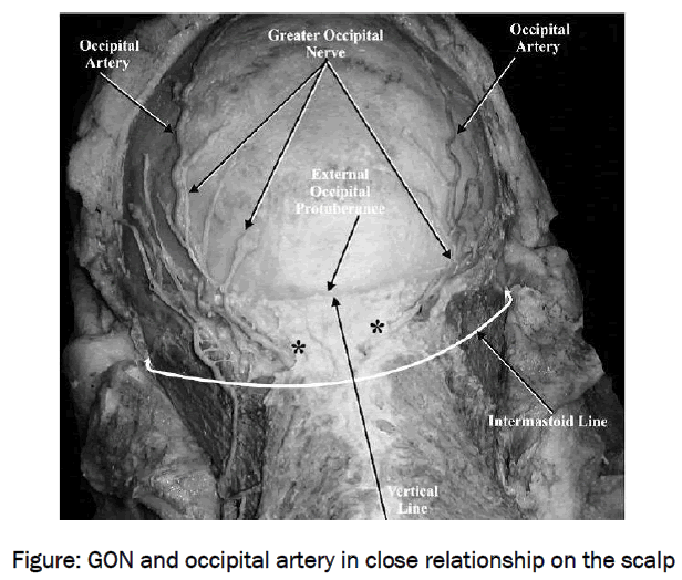 medical-health-sciences-GON-occipital-artery-close