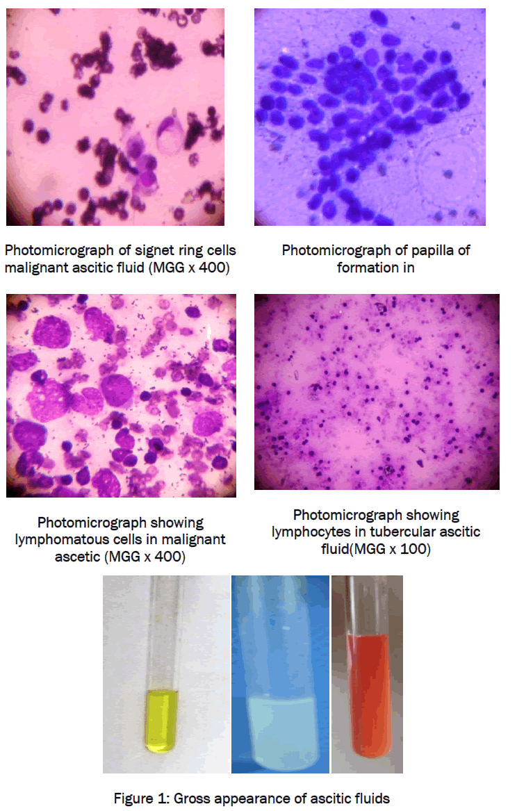 medical-health-sciences-Gross-appearance-ascitic-fluids