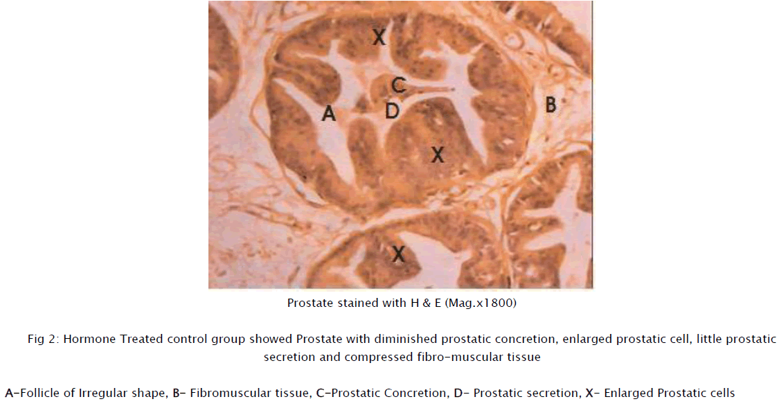 normal size prostate gland with concretions)