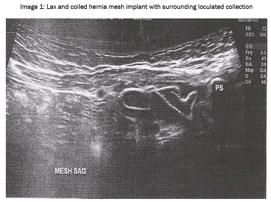 medical-health-sciences-Lax-coiled-hernia-mesh