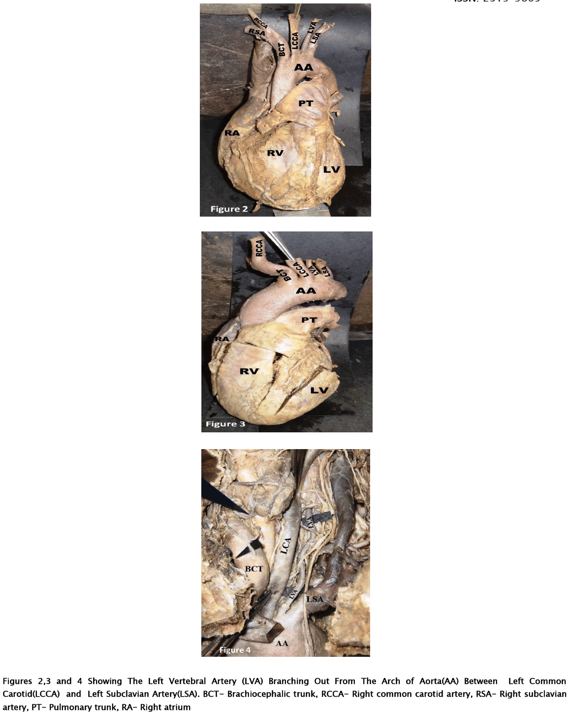 medical-health-sciences-Left-Vertebral-Artery