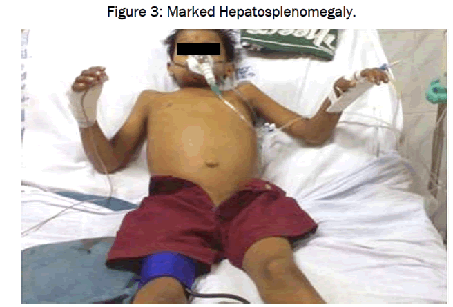 medical-health-sciences-Marked-Hepatosplenomegaly