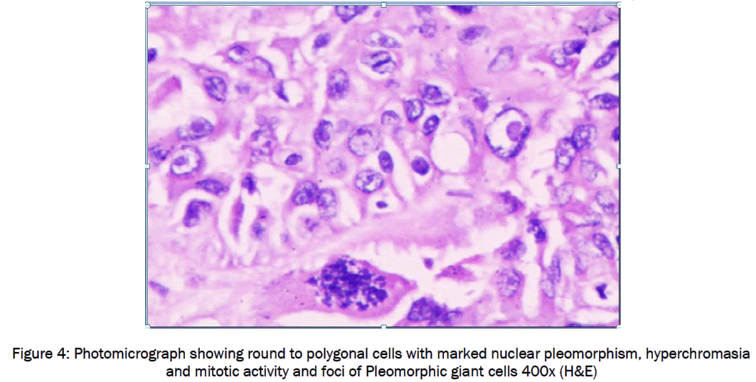 medical-health-sciences-Photomicrograph-showing-Pleomorphic-giant