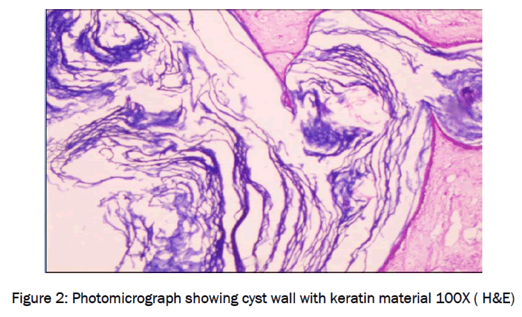 medical-health-sciences-Photomicrograph-showing-cyst-wall