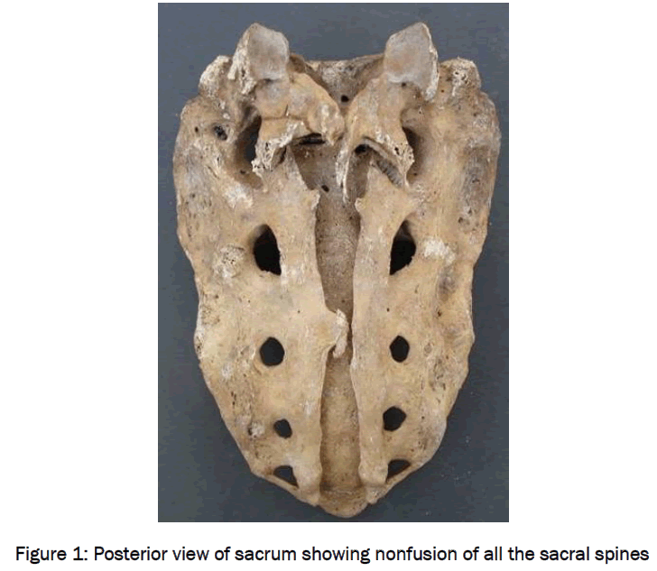 medical-health-sciences-Posterior-view-sacrum-showing