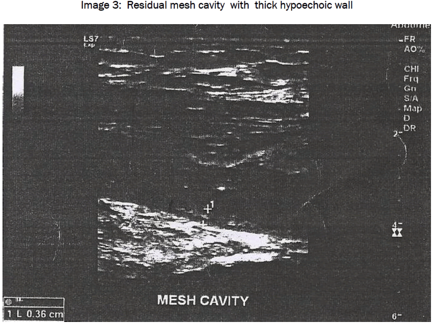 medical-health-sciences-Residual-mesh-cavity-thick