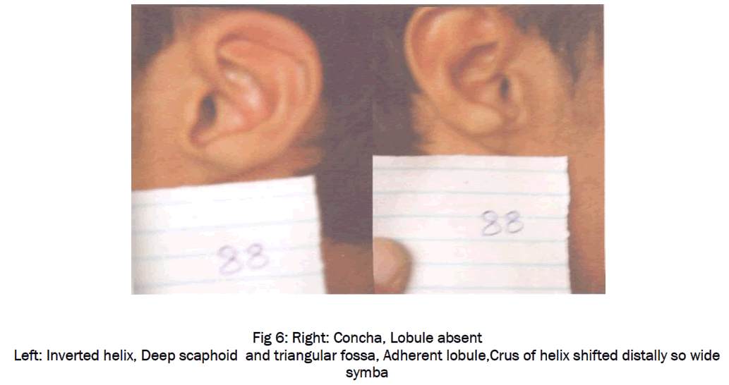 medical-health-sciences-Right-Concha-Lobule-absent