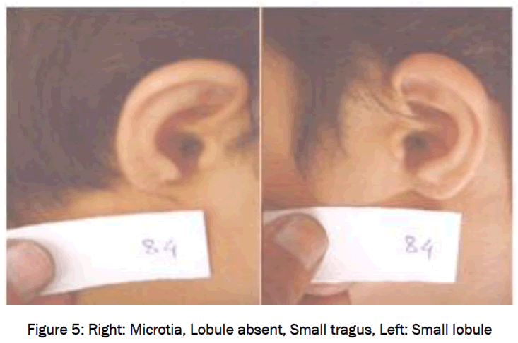 medical-health-sciences-Right-Microtia-Lobule-absent