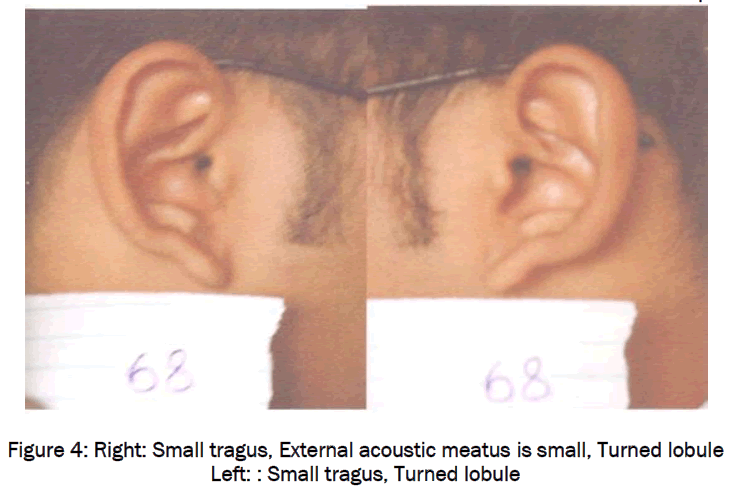 medical-health-sciences-Right-Small-tragus-External