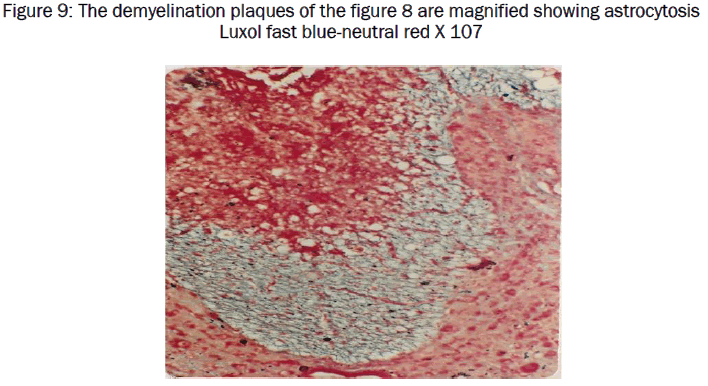 medical-health-sciences-The-demyelination-plaques-magnified