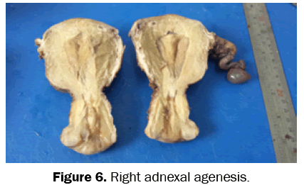 medical-health-sciences-adnexal-agenesis