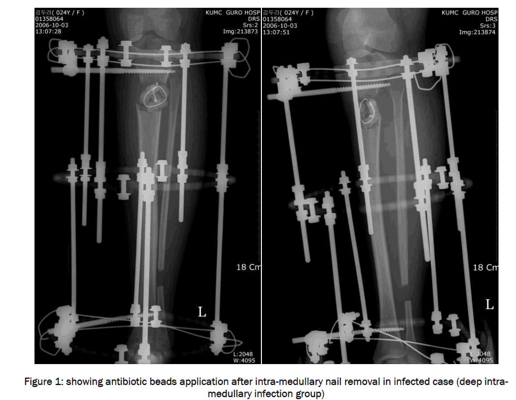 medical-health-sciences-intra-medullary