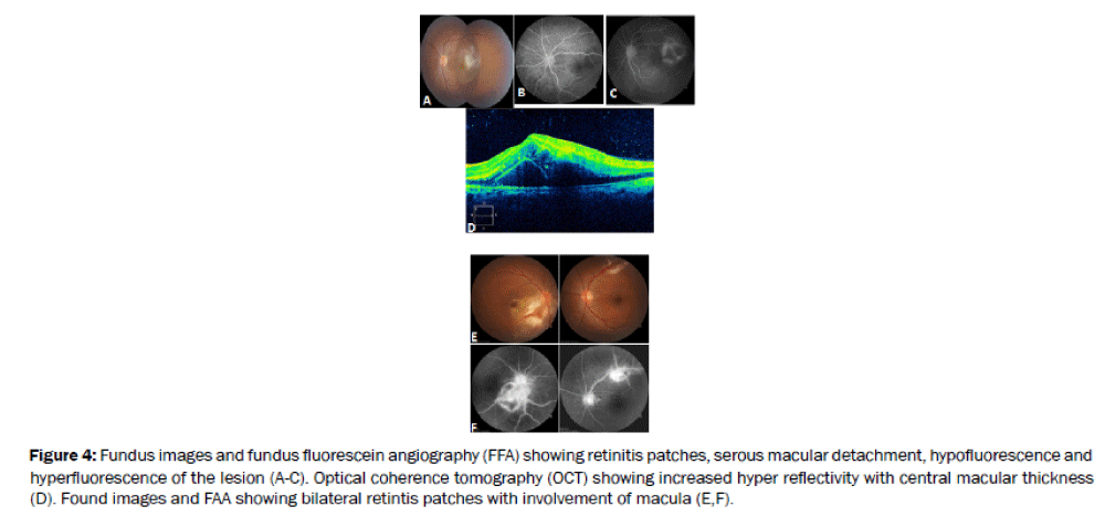 microbiology-biotechnology-macular-detachment