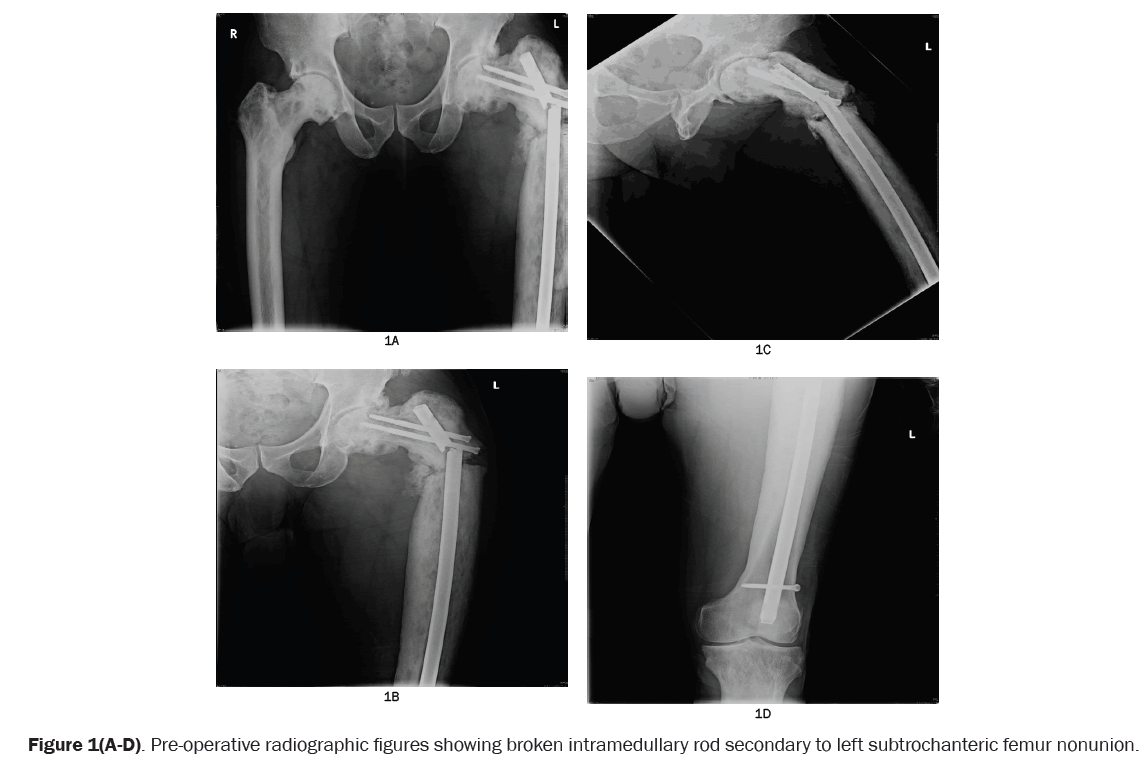 orthopedics-broken-intramedullary