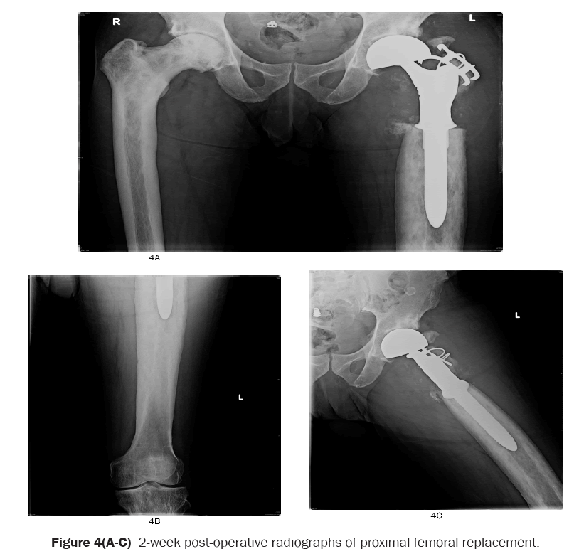 orthopedics-proximal-femoral-replacement