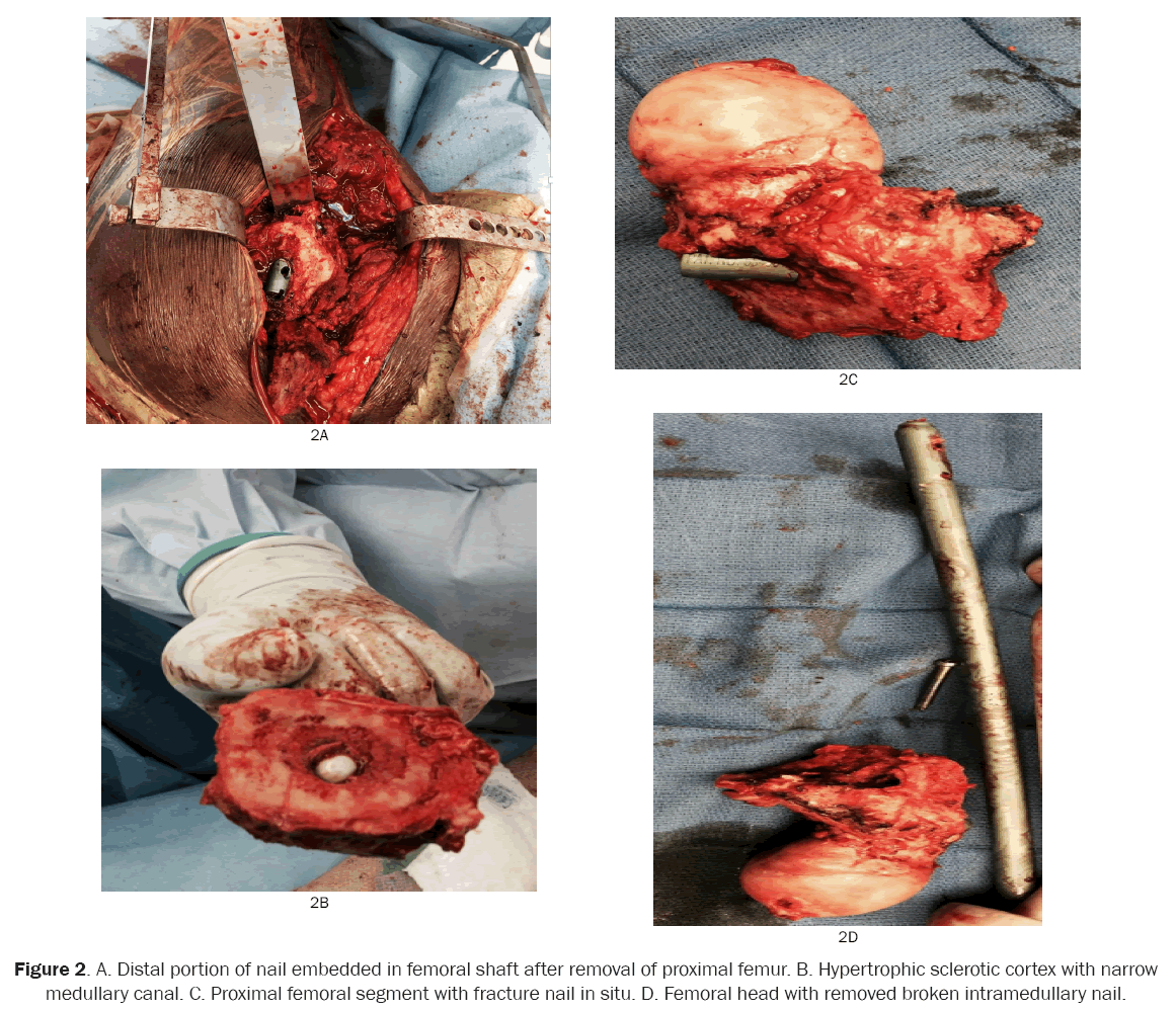 orthopedics-proximal-femur