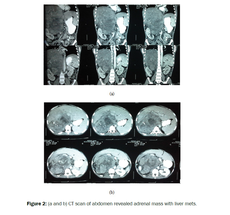 reports-cancer-treatments-adrenal-mass